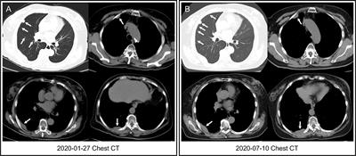 Case report: 18F-FES PET/CT predicted treatment responses of second-line and third-line CDK4/6 inhibitors after disease progression on first-line CDK4/6 inhibitor in a HR+/HER2- metastatic breast cancer patient